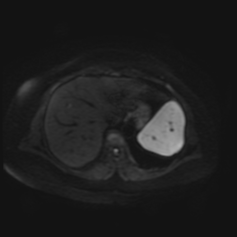 Adrenal cortical carcinoma (Radiopaedia 70906-81116 Axial DWI 5).jpg
