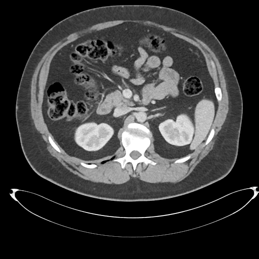 File:Adrenal cyst (Radiopaedia 45625-49778 AXIAL THICK 60 sec 30).png