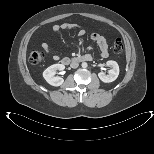 File:Adrenal cyst (Radiopaedia 45625-49778 AXIAL THICK 60 sec 41).png