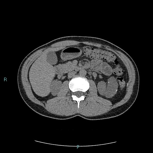 File:Adrenal cystic lymphangioma (Radiopaedia 83161-97534 Axial non-contrast 39).jpg