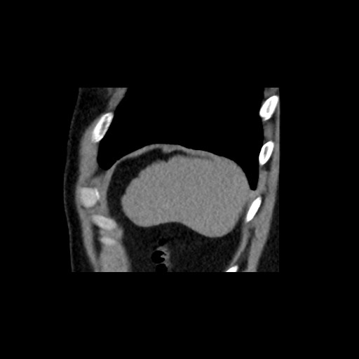 File:Adrenal gland trauma (Radiopaedia 81351-95079 Sagittal non-contrast 91).jpg