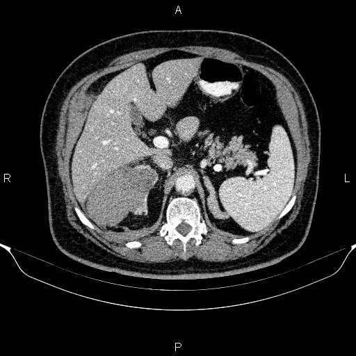 Adrenal hemorrhage (Radiopaedia 62622-70916 Axial C+ portal venous phase 52).jpg