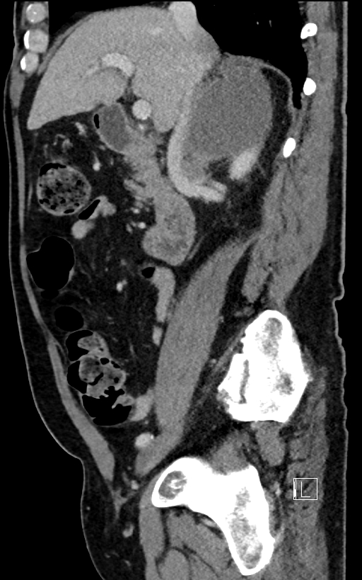 Adrenal lymphoma (Radiopaedia 73730-84529 Sagittal C+ portal venous phase 43).jpg