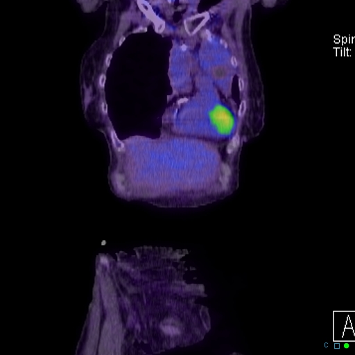 File:Adrenal metastasis from small cell lung cancer (Radiopaedia 19133-19109 Coronal 1).jpg