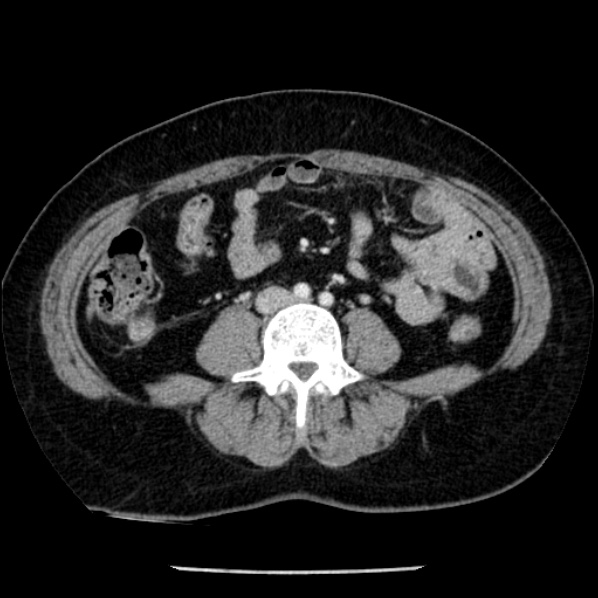 Adrenal myelolipoma (Radiopaedia 43401-46759 Axial C+ portal venous phase 51).jpg