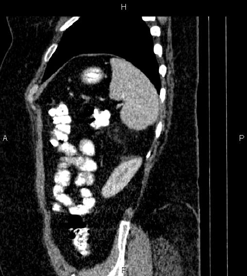 Adrenal myelolipoma (Radiopaedia 84319-99617 Sagittal renal cortical phase 81).jpg