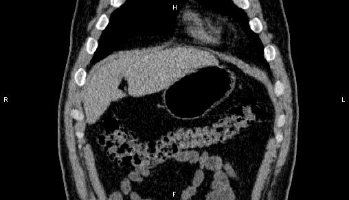 Adrenal myelolipoma (Radiopaedia 84321-99619 Coronal non-contrast 11).jpg