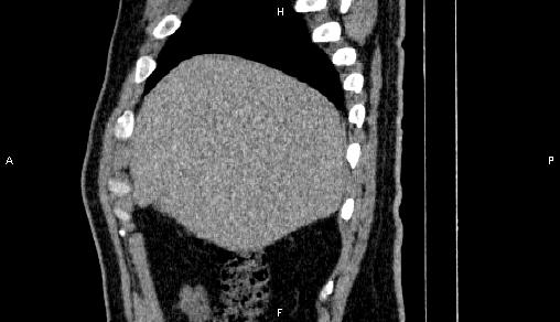 File:Adrenal myelolipoma (Radiopaedia 84321-99619 Sagittal non-contrast 17).jpg