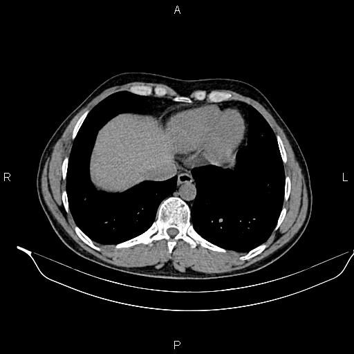 File:Adrenal myelolipoma (Radiopaedia 87794-104246 Axial non-contrast 13).jpg