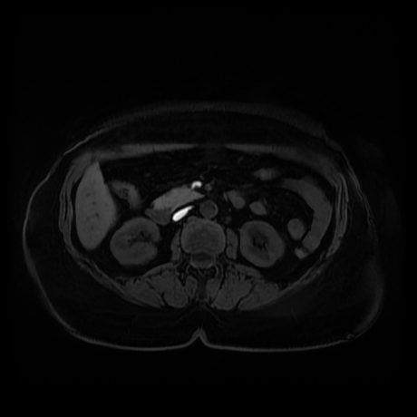 Adrenal myelolipoma - MRI (Radiopaedia 83249-97646 Axial T1 fat sat 47).jpg