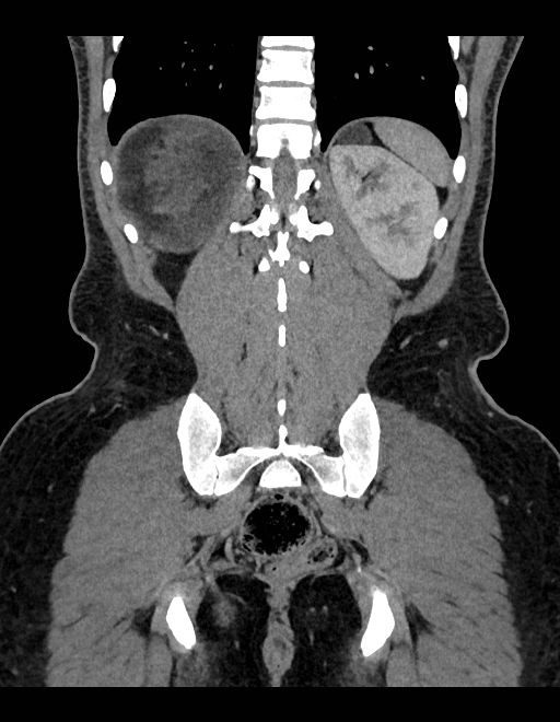 Adrenal myelolipoma - bilateral (Radiopaedia 74805-85810 Coronal C+ portal venous phase 85).jpg