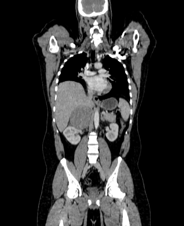 Adrenocortical carcinoma (Radiopaedia 80134-93438 Coronal C+ portal venous phase 93).jpg