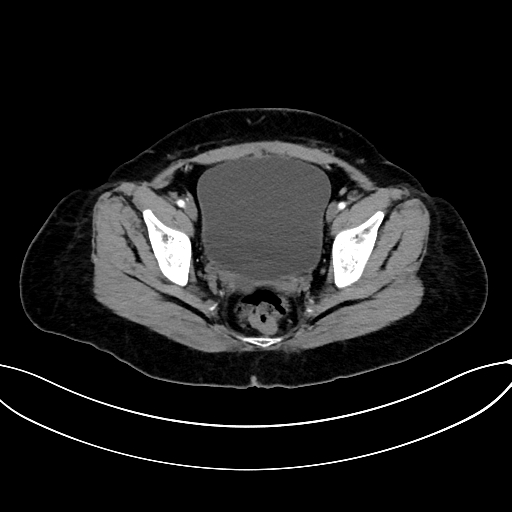 Adrenocortical carcinoma (Radiopaedia 87281-103569 Axial C+ arterial phase 78).jpg