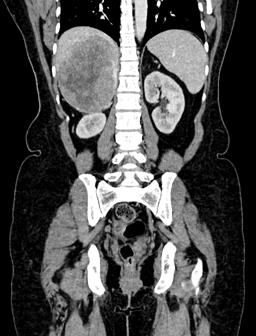 Adrenocortical carcinoma (Radiopaedia 87281-103569 Coronal C+ portal venous phase 90).jpg