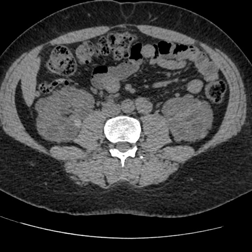 Adult polycystic kidney disease (Radiopaedia 59075-66368 Axial non-contrast 48).jpg