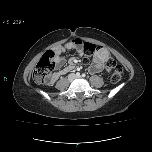 File:Adult transient intestinal intussusception (Radiopaedia 34853-36310 Axial C+ portal venous phase 56).jpg