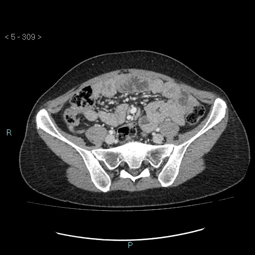 Adult transient intestinal intussusception (Radiopaedia 34853-36310 Axial C+ portal venous phase 72).jpg
