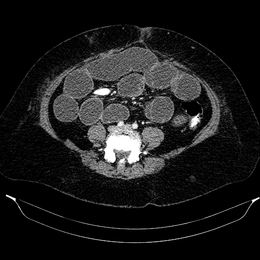 Afferent loop syndrome - secondary to incarcerated trocar site hernia (Radiopaedia 82959-97305 Axial C+ portal venous phase 155).jpg