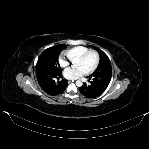 File:Afferent loop syndrome - secondary to incarcerated trocar site hernia (Radiopaedia 82959-97305 Axial C+ portal venous phase 2).jpg