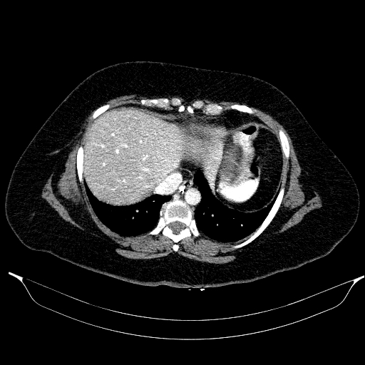 Afferent loop syndrome - secondary to incarcerated trocar site hernia (Radiopaedia 82959-97305 Axial C+ portal venous phase 28).jpg