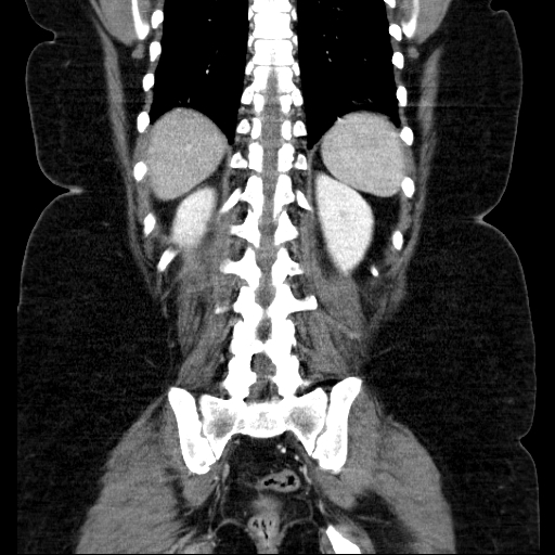 File:Afferent loop syndrome - secondary to incarcerated trocar site hernia (Radiopaedia 82959-97305 Coronal C+ portal venous phase 112).jpg