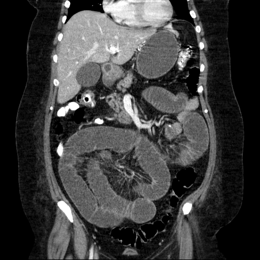 File:Afferent loop syndrome - secondary to incarcerated trocar site hernia (Radiopaedia 82959-97305 Coronal C+ portal venous phase 66).jpg