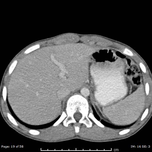 File:Agenesis of the gallbladder (Radiopaedia 55454-61905 B 19).jpg
