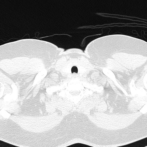 File:Air trapping in small airway disease (Radiopaedia 61685-69694 Axial lung window 2).jpg
