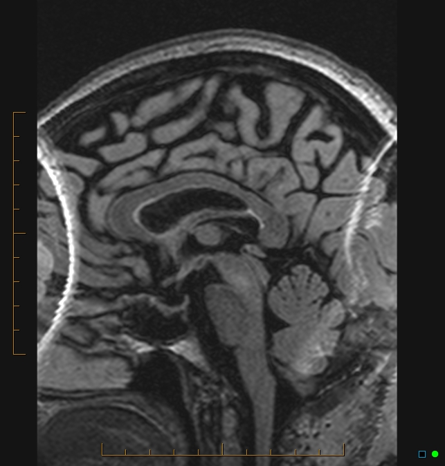 Aliasing artifact causing a spurious cerebellar lesion (Radiopaedia 48783-53810 Sagittal FLAIR 43).jpg
