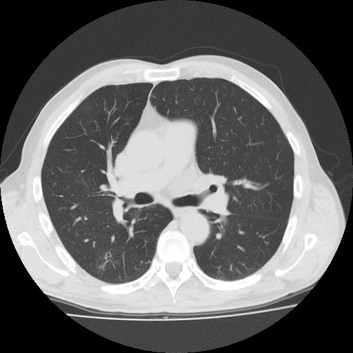 Allergic bronchopulmonary aspergillosis (ABPA) (Radiopaedia 60594-68313 Axial lung window 27).jpg