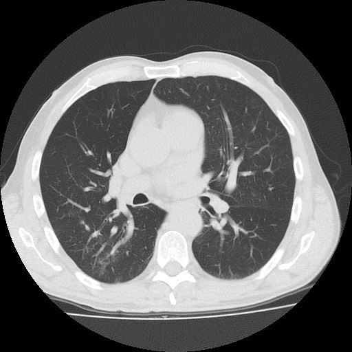 File:Allergic bronchopulmonary aspergillosis (ABPA) (Radiopaedia 60594-68313 Axial lung window 30).jpg