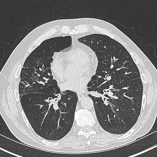 Allergic bronchopulmonary aspergillosis (Radiopaedia 44760-48571 Axial lung window 39).png