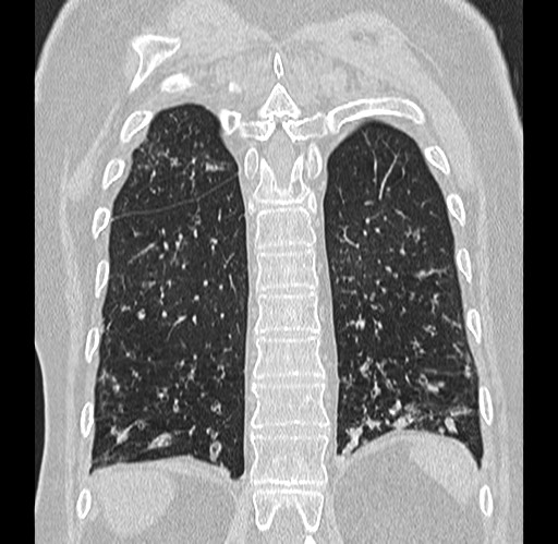 Alpha-1-antitrypsin deficiency (Radiopaedia 72058-82557 Coronal lung window 81).jpg