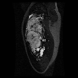 Alveolar soft part sarcoma (Radiopaedia 64501-73678 D 104).jpg
