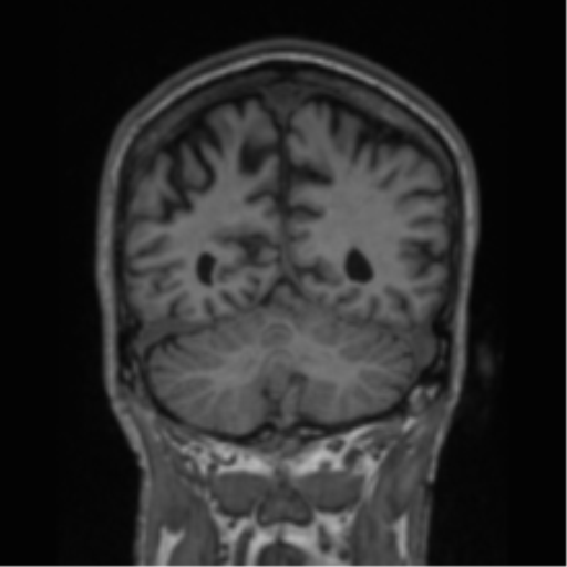 File:Alzheimer's disease- with apraxia (Radiopaedia 54763-61011 Coronal T1 30).png