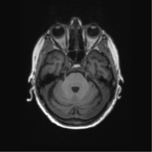 File:Alzheimer's disease (Radiopaedia 42658-45802 Axial T1 110).png