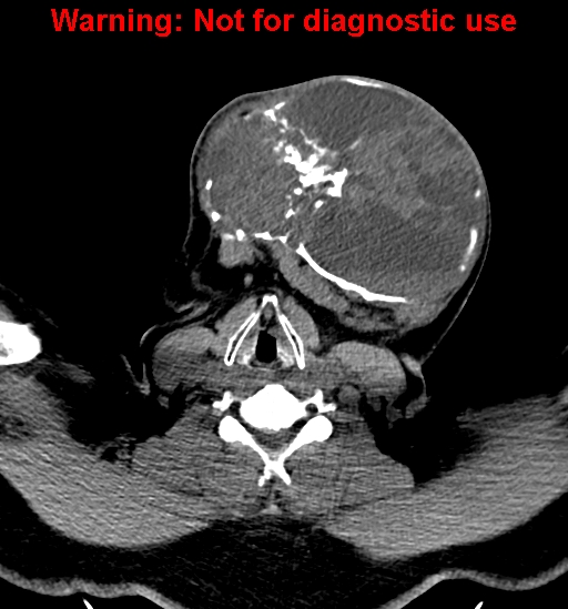 File:Ameloblastoma (Radiopaedia 33126-34164 A 24).jpg