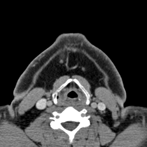 File:Ameloblastoma (Radiopaedia 33677-34806 Axial non-contrast 36).png