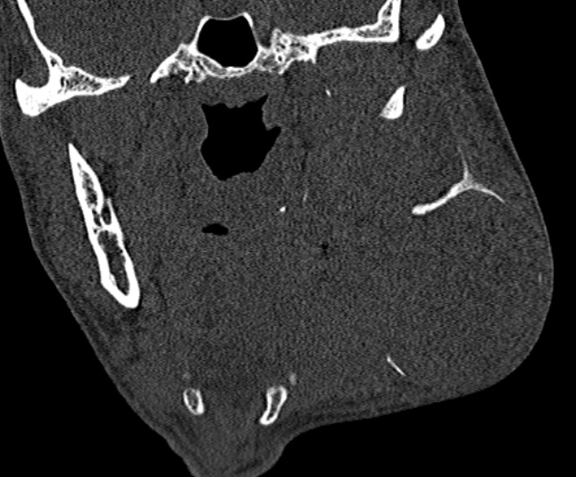Ameloblastoma (Radiopaedia 51921-57766 Coronal bone window 150).jpg
