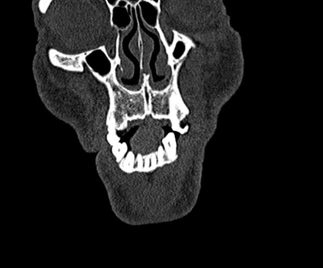 Ameloblastoma (Radiopaedia 51921-57766 Coronal bone window 27).jpg