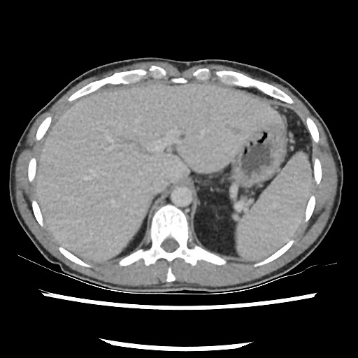 Amoebic liver abscesses (Radiopaedia 55536-62010 A 22).jpg