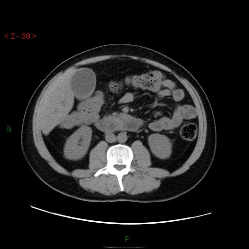 File:Ampullary carcinoma (Radiopaedia 56396-63056 Axial non-contrast 26).jpg