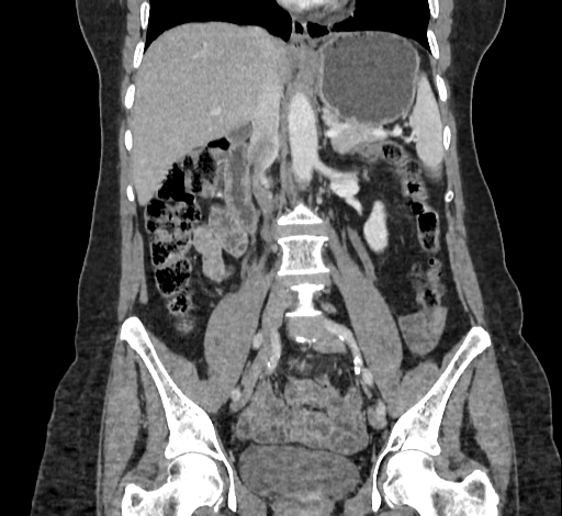 Ampullary tumor (Radiopaedia 60333-67998 B 42).jpg