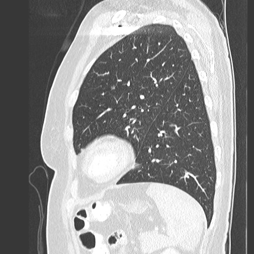 Amyloidosis - bronchial and diffuse nodular pulmonary involvement (Radiopaedia 60156-67745 Sagittal lung window 70).jpg
