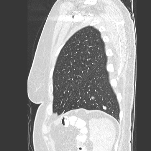 File:Amyloidosis - bronchial and diffuse nodular pulmonary involvement (Radiopaedia 60156-67745 Sagittal lung window 79).jpg