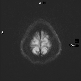 File:Amyotrophic lateral sclerosis (Radiopaedia 70821-81017 Axial DWI 16).jpg