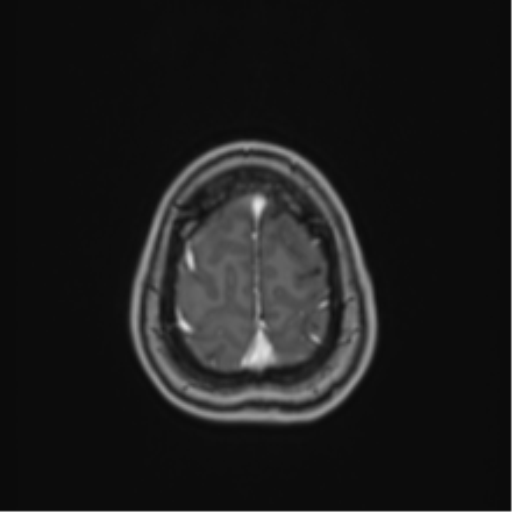 File:Anaplastic astroblastoma (Radiopaedia 55666-62194 Axial T1 C+ 68).png
