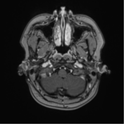 File:Anaplastic astroblastoma (Radiopaedia 55666-62194 Axial T1 C+ 9).png