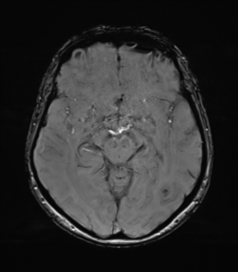 File:Anaplastic astrocytoma (Radiopaedia 86943-103160 Axial SWI 41).png