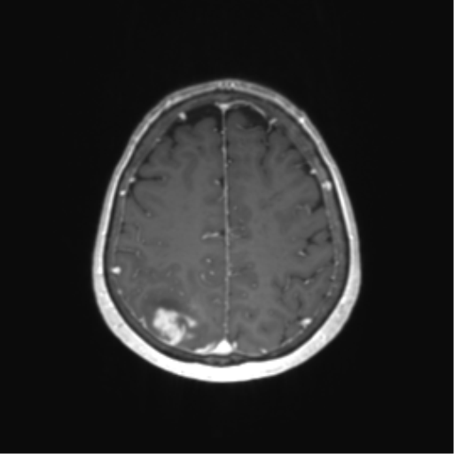 File:Anaplastic astrocytoma (Radiopaedia 86943-103160 Axial T1 C+ 62).png
